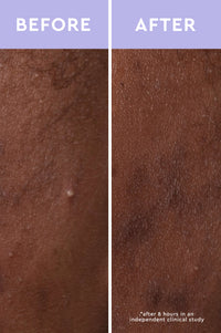 Spot a Spot Acne Patches