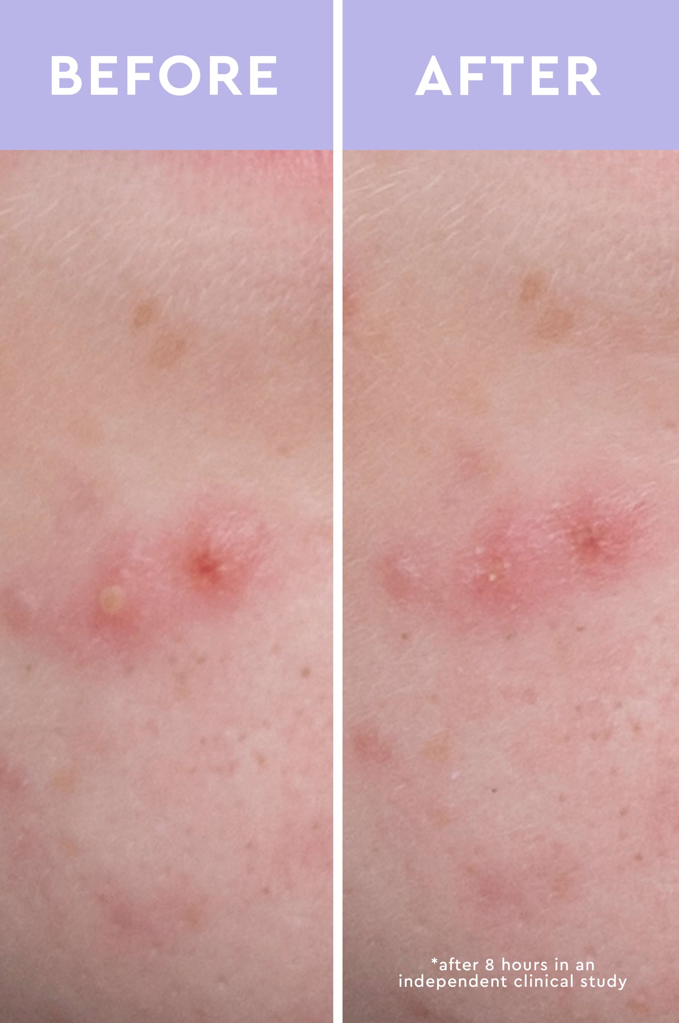 Spot a Spot Acne Patches